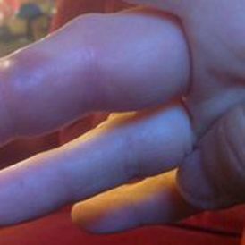 Bee Stings and Home Remedies Image